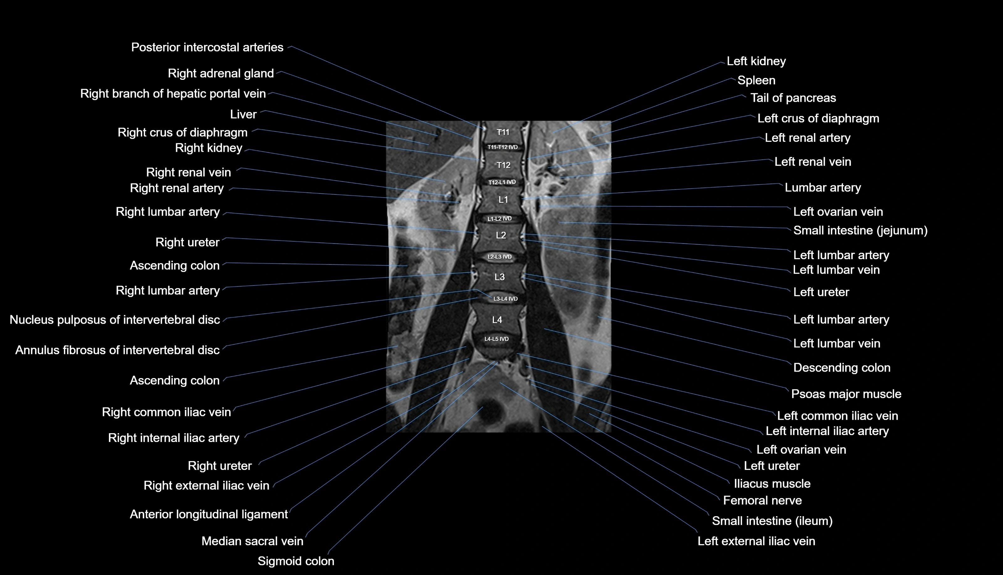 MRI lumbar spine labelled coronal cross sectional anatomy 3T radiology-img-00001-00010.webp